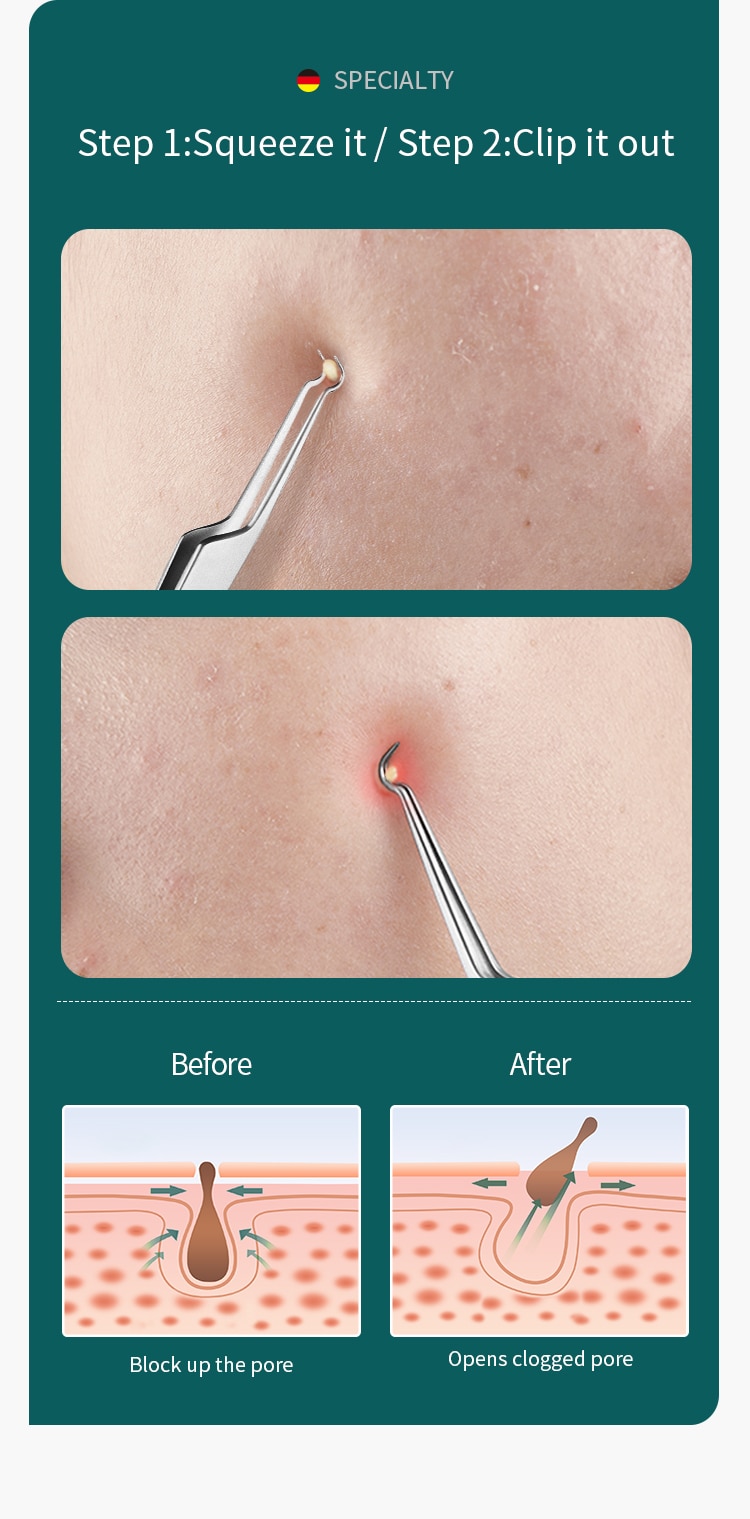 Professional Acne Remover Needle